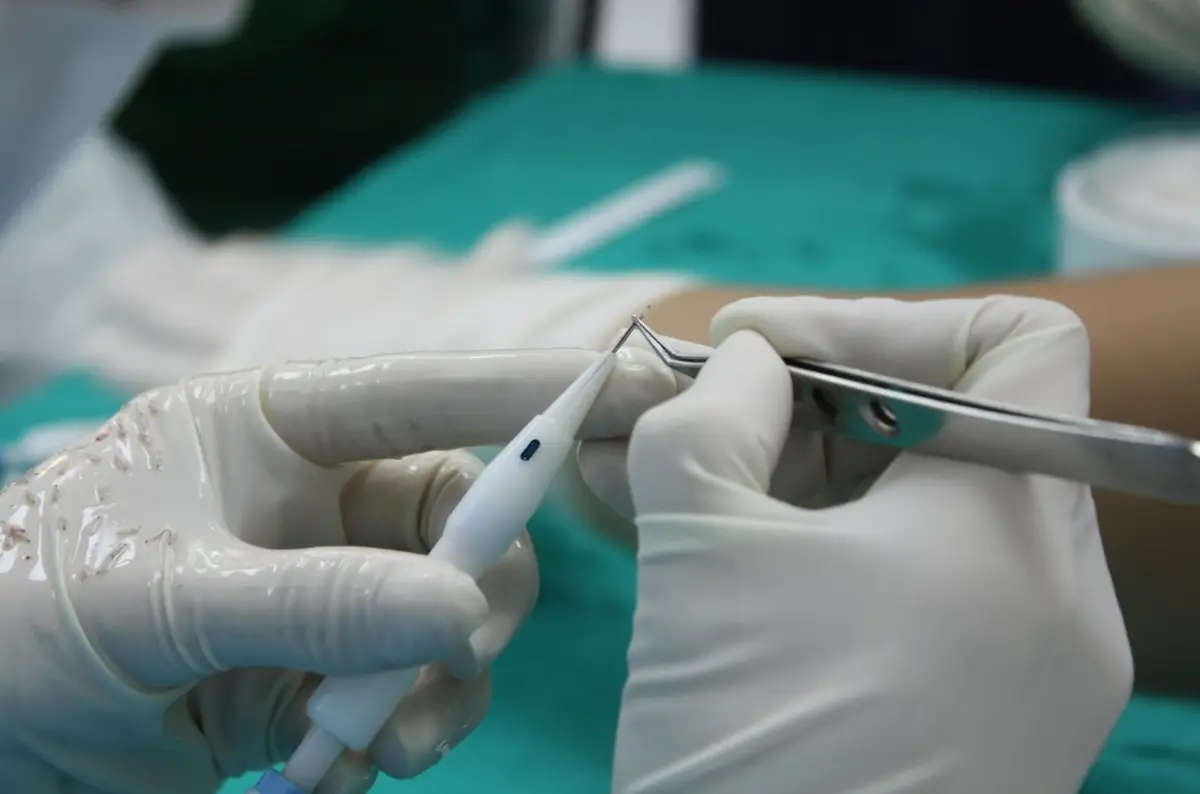 Hands handling follicles with precision for hair restoration