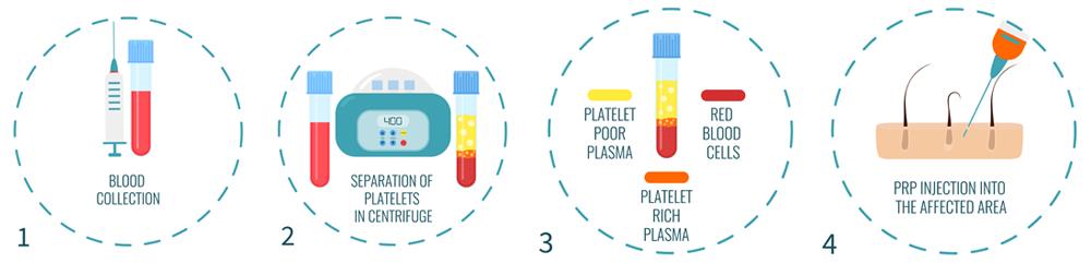 Step-by-step PRP therapy process for hair growth.