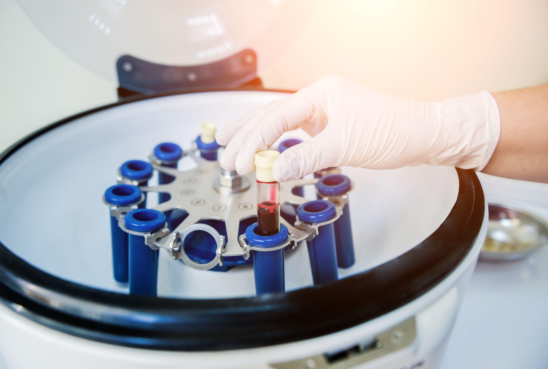 PRP hair restoration treatment at clinic.