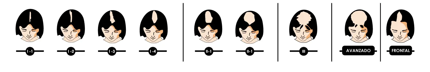 Ludwig hair loss scale