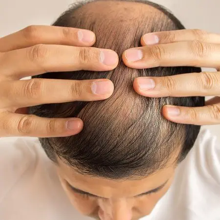 Minoxidil application guide