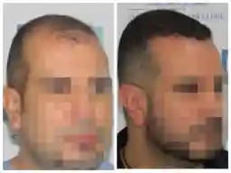 Patient 2 before and after hair transplant Panama