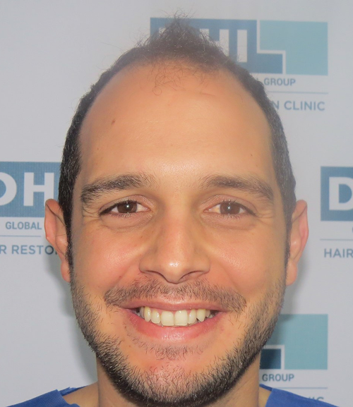 Patient with male pattern baldness before hair transplant procedure in Panama