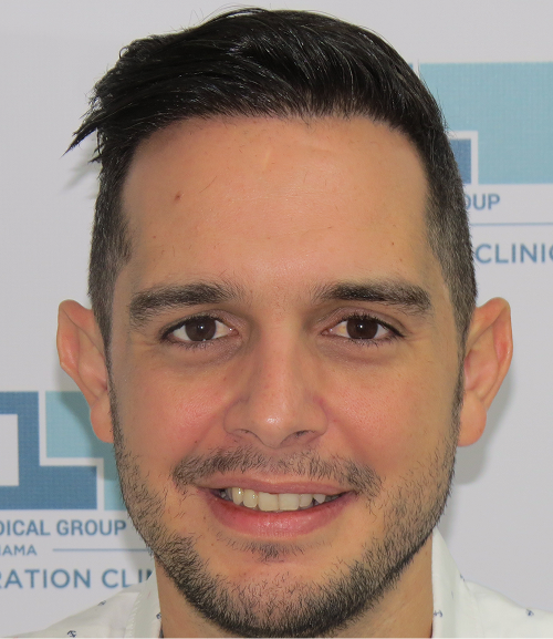 Patient showing hair restoration results after DHI hair transplant procedure in Panama